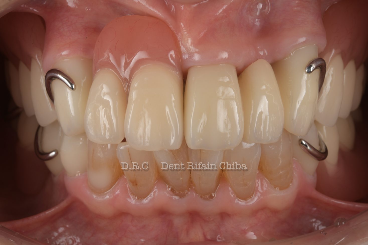 ジルコニアBrとパーシャルデンチャーのコンビネーション | D.R.C歯科技工所